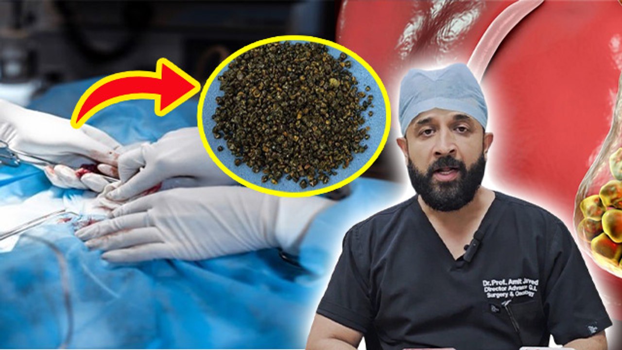 GallBladder Stones Reason: Haryana में 70 Year Old Men के निकली 8125 Stones, Symptoms and Treatment
