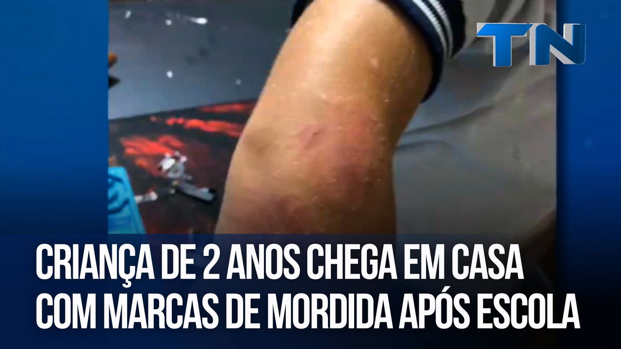 Criança de 2 anos chega em casa com marcas de mordida após escola ...