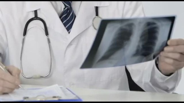 Tumore al polmone Alk-positivo in fase precoce, nuove prospettive