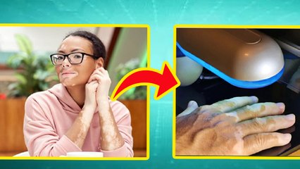 20 साल पुराना सफेद दाग कैसे ठीक करें,जड़ से ठीक करने का सबसे तेज तरीका |Boldsky