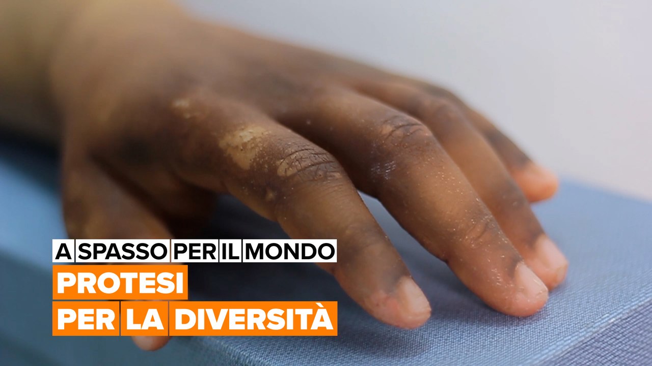 A spasso per il mondo: Protesi per la diversità
