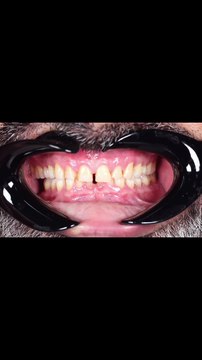 Real Smiles, Real People: A Smile Makeover Story | Smile Transformation