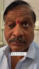 अक्षि तर्पण का चमत्कार | HIIMS में आंखों को मिला नया जीवन, जो आंख पहले पूरी नहीं खुलती थी, अब हो गई सामान्य