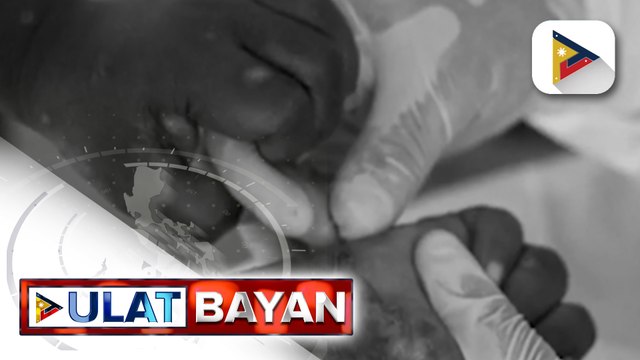 DOH, pinawi ang pangamba ng publiko kaugnay sa mga kaso ng Mpox sa iba't ibang lugar sa bansa