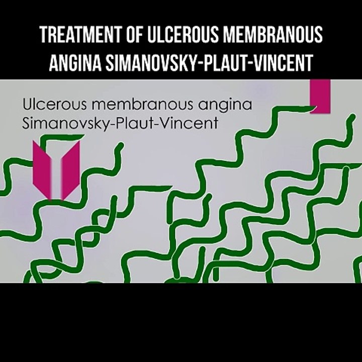 Treatment of ulcerous membranous angina Simanovsky-Plaut-Vincent ...