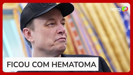 Musk aparece com olho roxo em despedida do governo Trump e diz que levou soco do filho de 5 anos