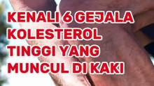 Kenali 6 Gejala Kolesterol Tinggi yang Muncul di Kaki