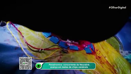 Paradromics: concorrente da Neuralink avança em testes de chips cerebrais