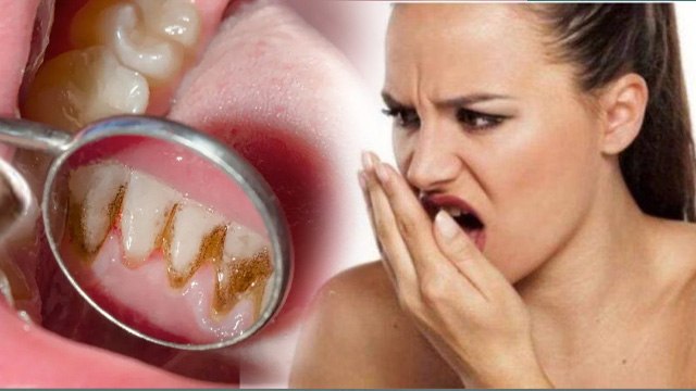 Halitosis Causes: मुंह से बदबू क्यों आती है, हैलिटोसिस क्या है, Symptoms & Treatment