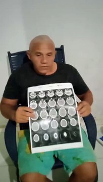 Em Patos: servente de pedrerio faz apelo por cirurgia urgente para retirada de lipoma na cabeça