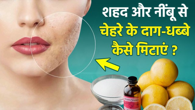 Honey and Lemon For Dark Spots: चेहरे पर शहद और नींबू लगाने से गायब होंगे दाग-धब्बे, जानें तरीका