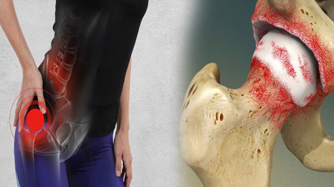 Hip Arthritis Causes: हिप अर्थराइटिस क्या है, Symptoms & Treatment | Boldsky