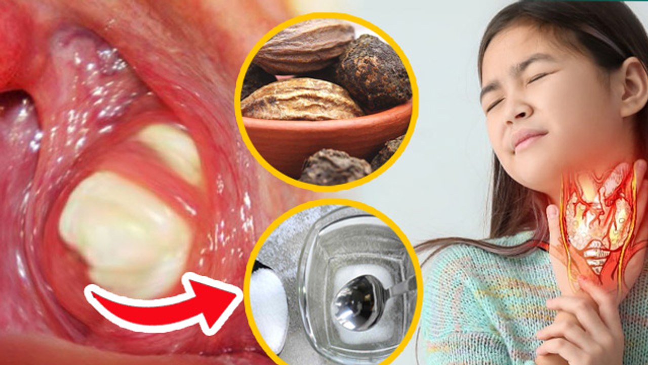 Tonsil Stones Causes:टॉन्सिल स्टोन्स क्यों होते हैं,Symptoms & Treatment In Hindi | Boldsky
