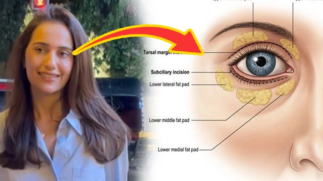 Kusha Kapila Eye Lid Surgery: Blepharoplasty से क्या वाकई बदला लुक|Benefits, Side Effects & Price...