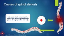 Causes of spinal stenosis