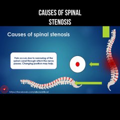 Causes of spinal stenosis