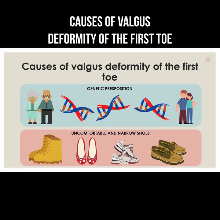 Causes of valgus deformity of the first toe