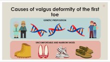 Causes of valgus deformity of the first toe