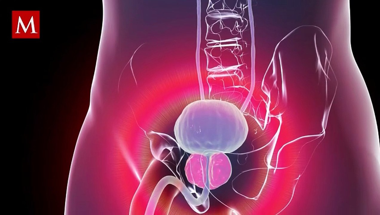 Cáncer de próstata: ¿Tienes estos síntomas? Señales CLAVE que debes saber