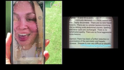 July 2023: how I’m beating inoperable stage IV pancreatic cancer