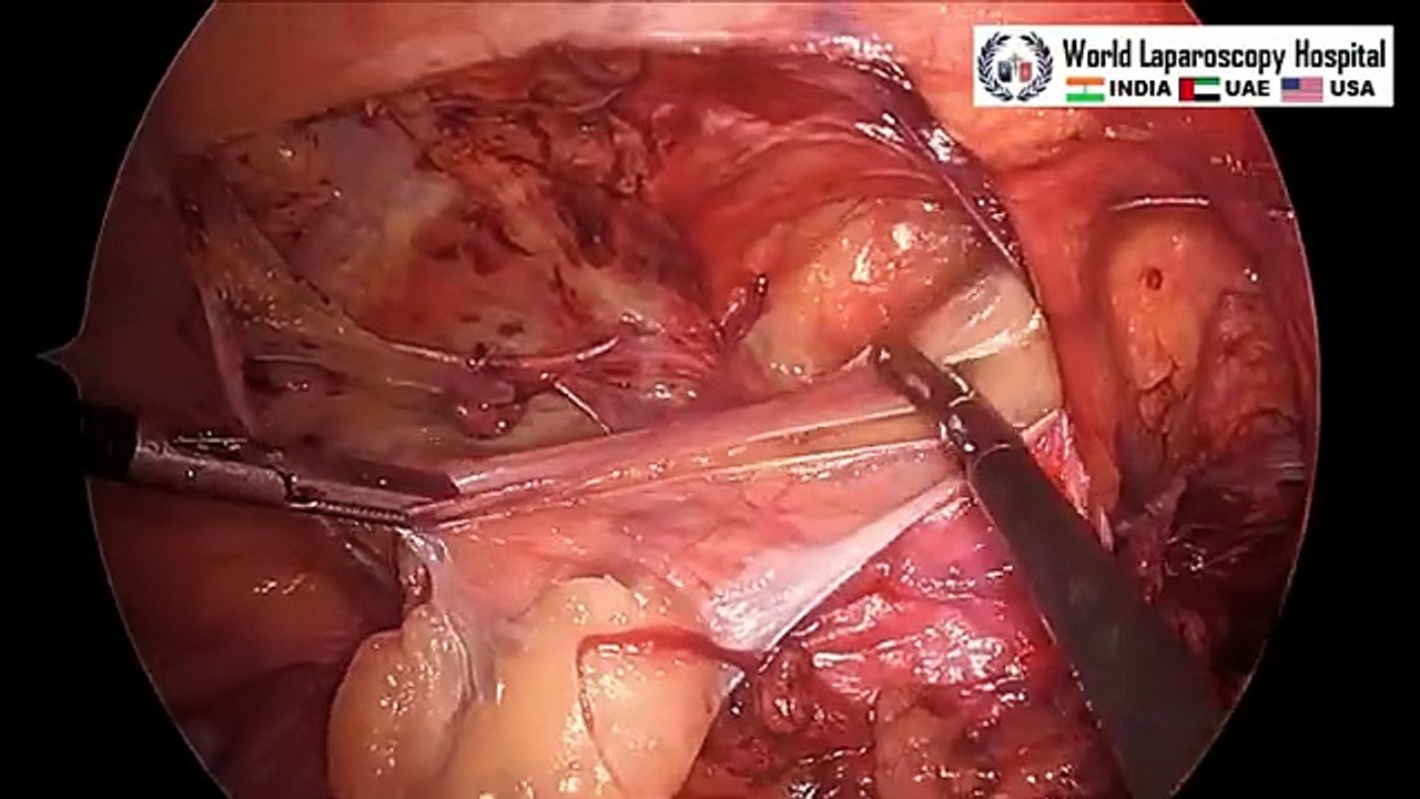 Bilateral Inguinal Hernia with Left sided Sliding Inguinal Hernia