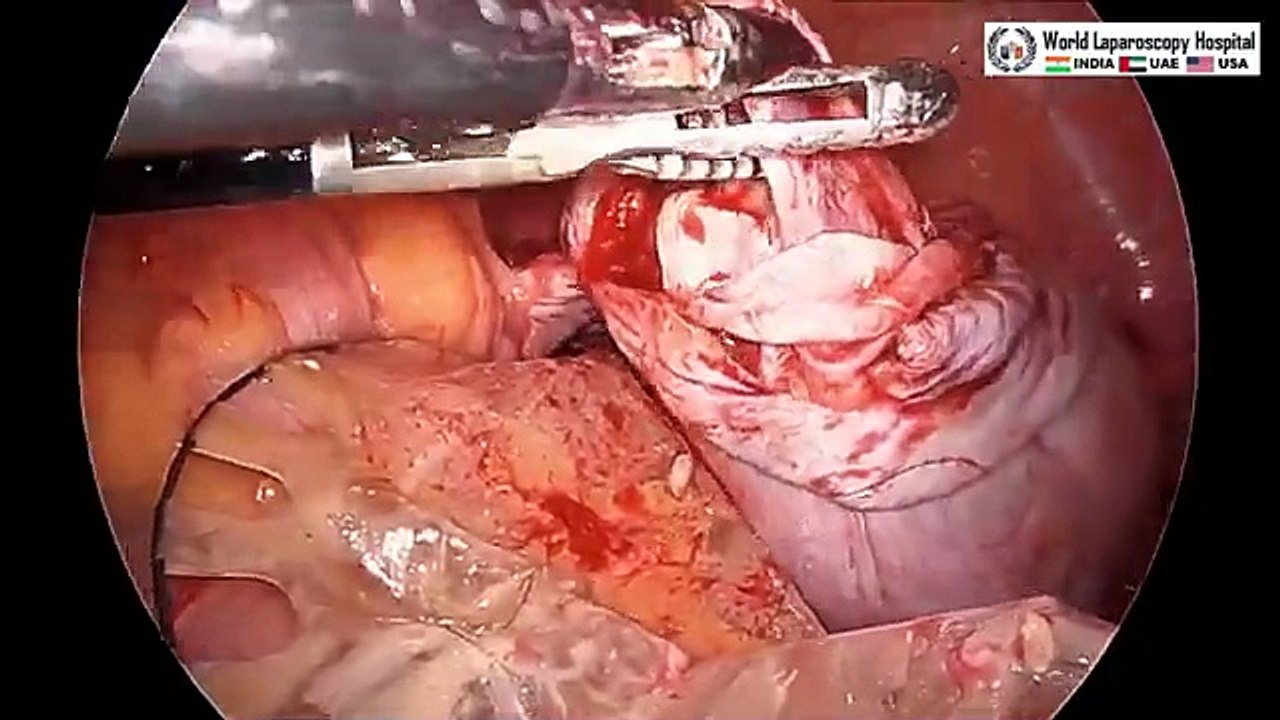 Bilateral Ovarian Dermoid Dermoid Cyst