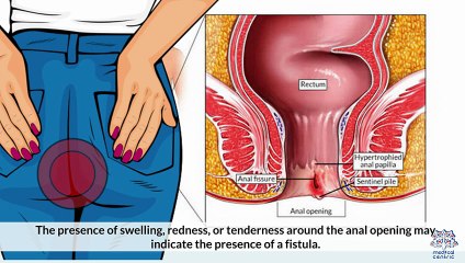 Best Doctor for Fistula Treatment in Chennai