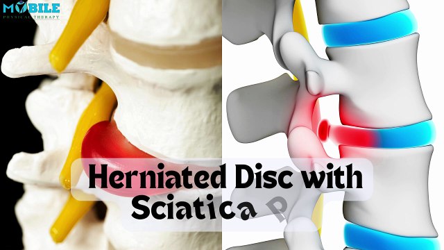 11 Best Exercises for Herniated Disc & Sciatica Pain Relief | Step-by-Step Guide