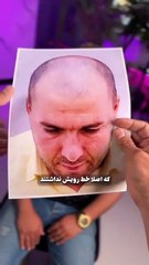 این آقا با این حجم تراکم اومد... و با اون حجم رفت! | تغییر فوق‌العاده بعد از کاشت مو