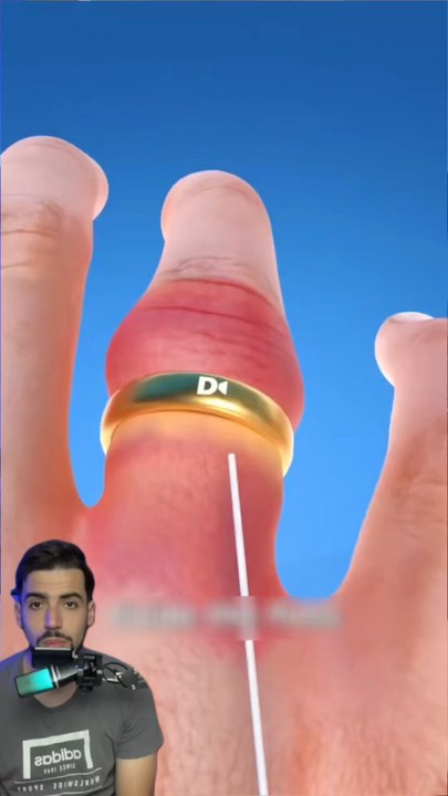 Retirer la bague