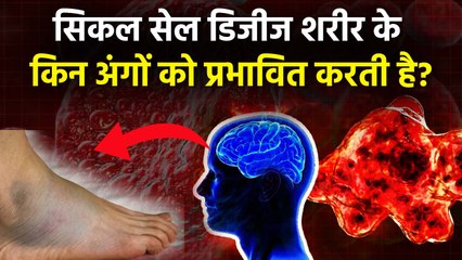 Sickle Cell Causes: सिकल सेल डिजीज शरीर के किन अंगों को प्रभावित करती है,Expert Advice | Boldsky