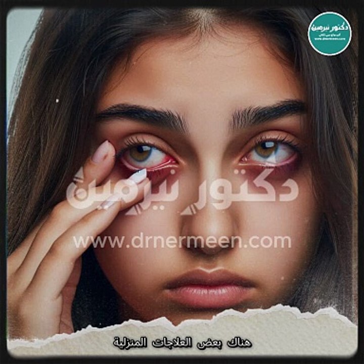 علاج تورم العين في المنزل viral #viralvide # #صحة #صحية #علاج #العين #تورم #عين #العيون