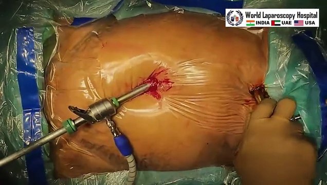 Port Efficiency - Laparoscopic Cholecystectomy, Appendectomy, and Tubal Ligation by same Port