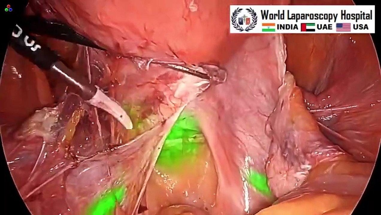 Enhance Safety in Total Laparoscopic Hysterectomy with Indocyanine Green (ICG) Fluorescence Imaging