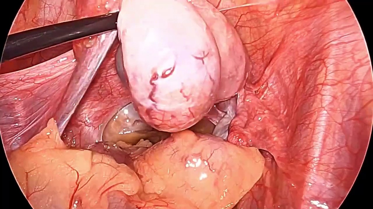 Vaginal Extraction of Specimen in Laparoscopic Surgery: Technique and Considerations
