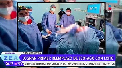 Hospital IMSS-Bienestar realiza con éxito cirugía de reemplazo total de esófago
