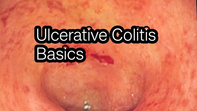 Ulcerative colitis