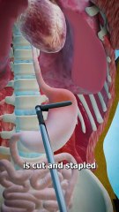 Gastric Bypass Surgery