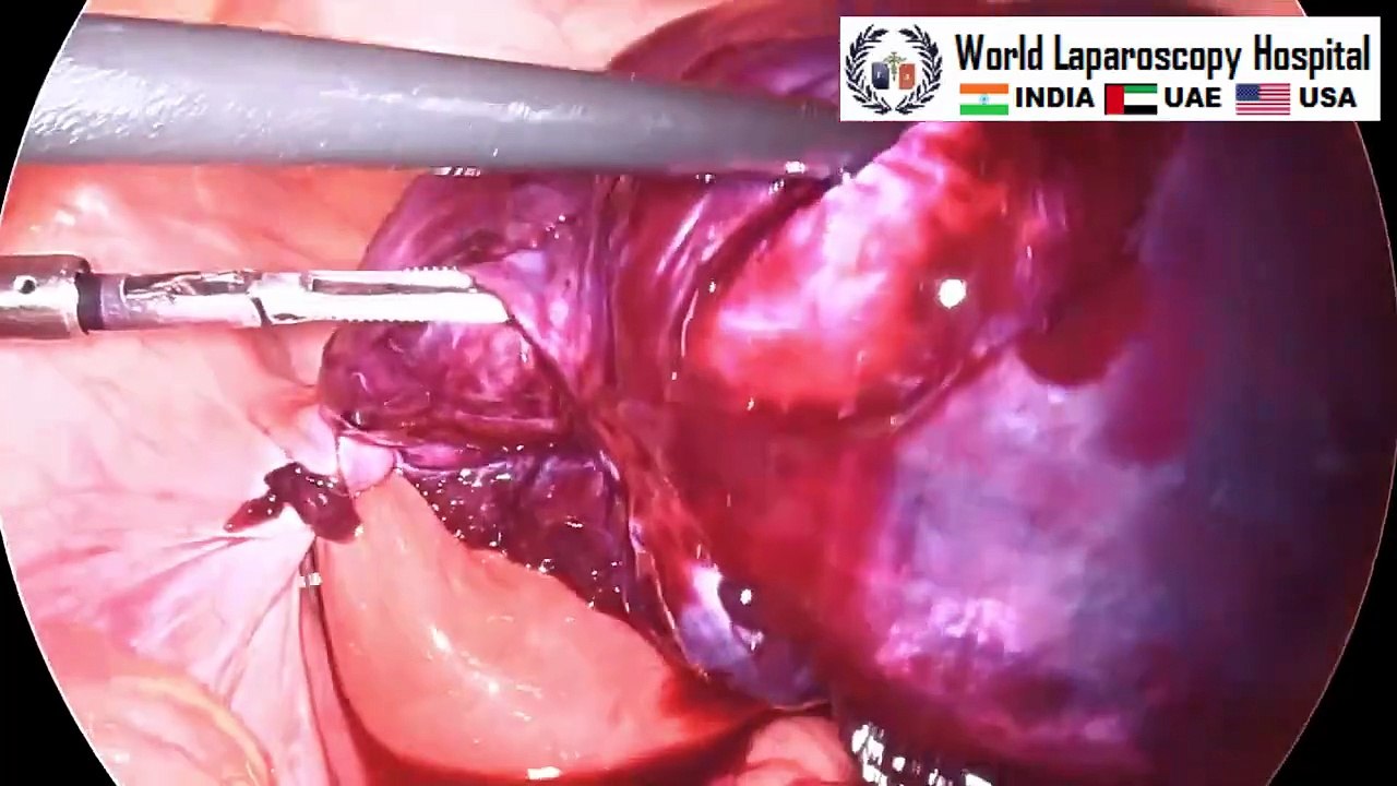 Laparoscopic Management of Ovarian Cyst Torsion
