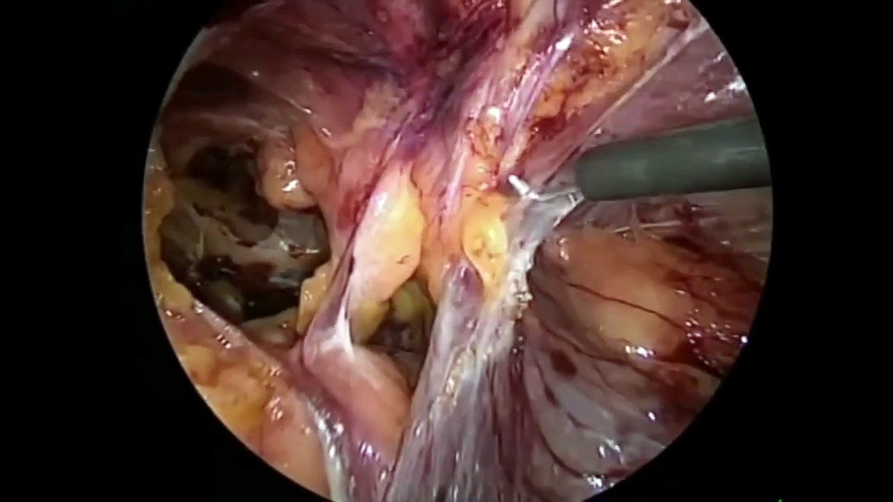 Laparoscopic Transabdominal Preperitoneal (TAPP) Hernia Repair by Suturing: A Comprehensive Approach