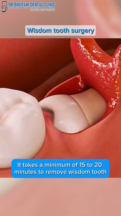 Removing a wisdom tooth doesn’t have to be stressful! At Dr. Bhutani Clinic, we ensure a painless and comfortable removal, usually done within just 20 minutes, including anesthesia. Your comfort is our priority!Tran