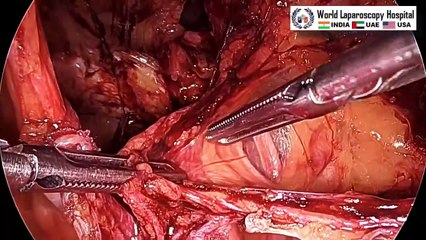 Mastering Bilateral Inguinal Hernia Repair: Tips and Techniques from World Laparoscopy Hospital