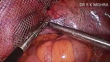 Ipom Inguinal Hernia Surgery by Suturing - Personnel Technique Dr R K Mishra