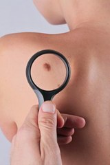 Come riconoscere il melanoma