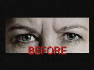 Non surgical procedures - Before and After photos