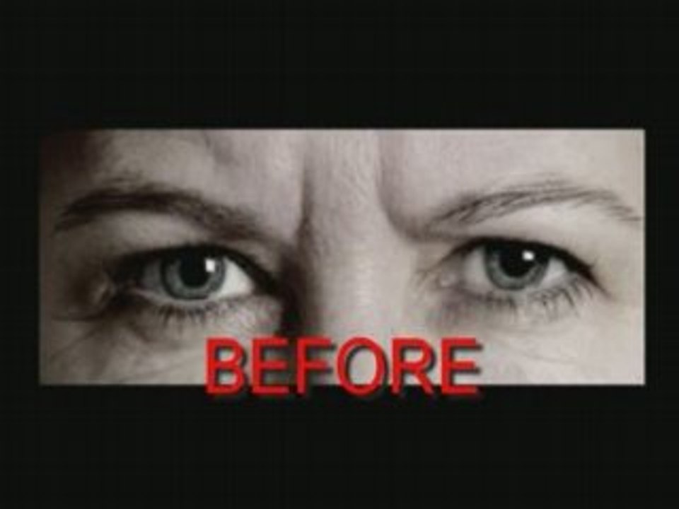 Non surgical procedures - Before and After photos