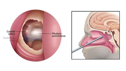 Endoscopic Endonasal Approach for Pituitary Tumor Removal