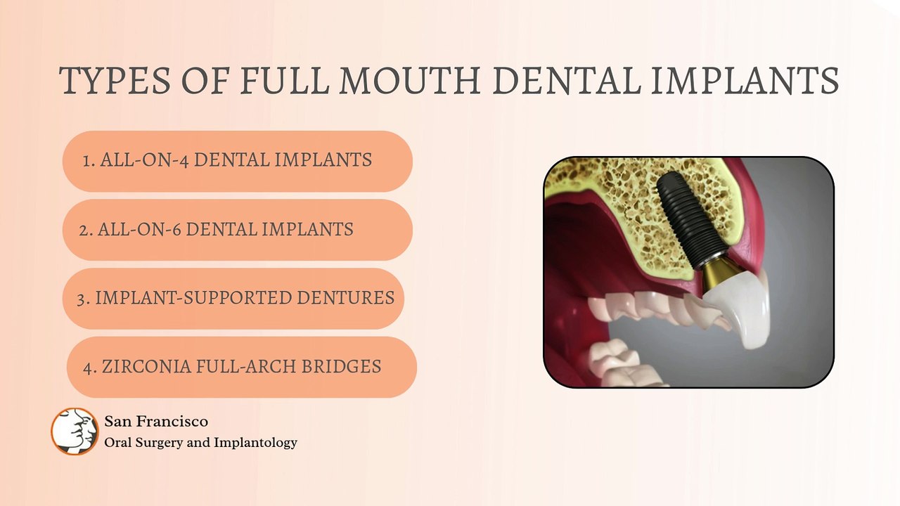 Explore full mouth dental implants and their types