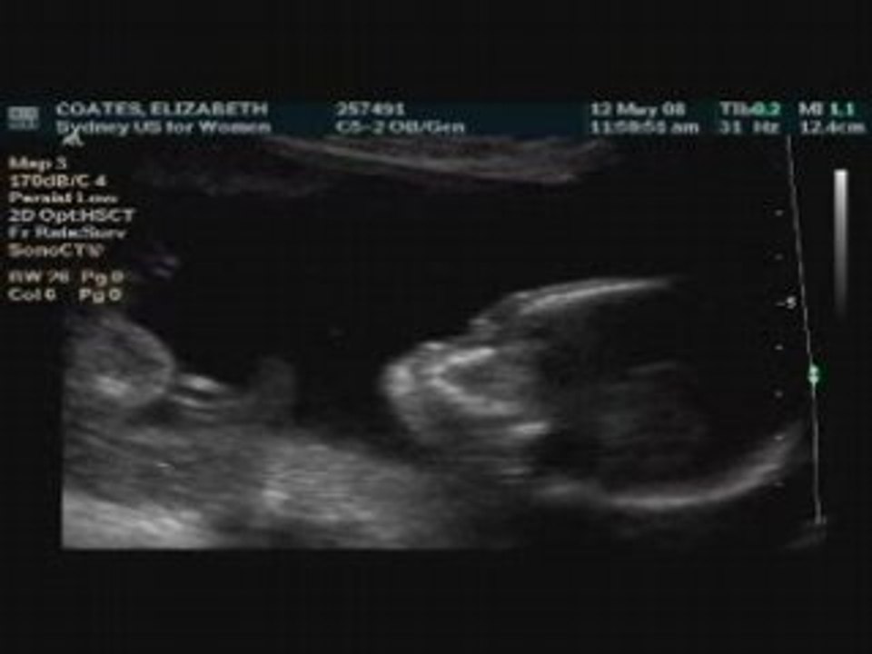 Ultrasound 30 second cut