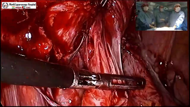 Recurrent Incisional Hernia with Severe Small Bowel Adhesion with Subacute Obstruction